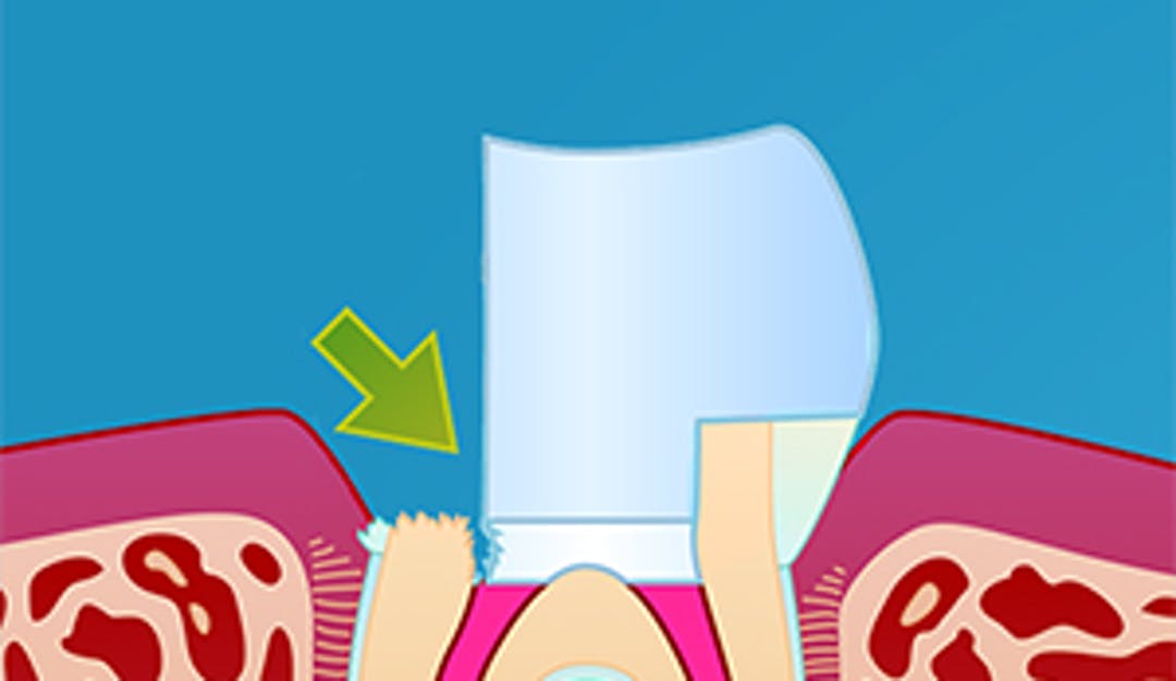 Revidering_rotfylling-_w300__92f01457ee35e59f48ad178ba583d93a