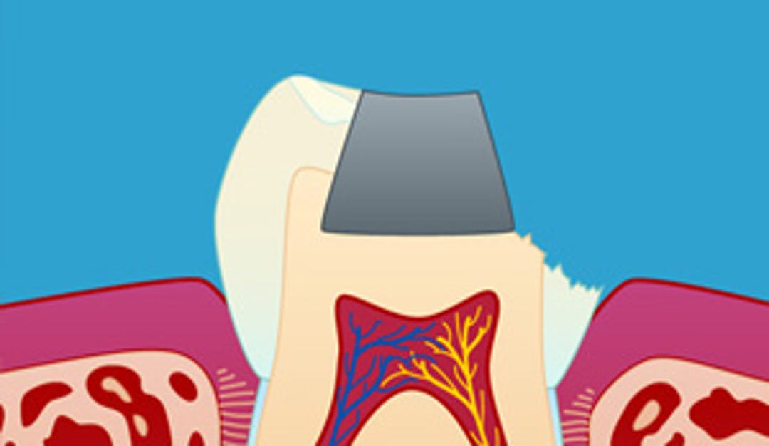 Tannfraktur_w300__ac633beae952881d92432f2cc170802c